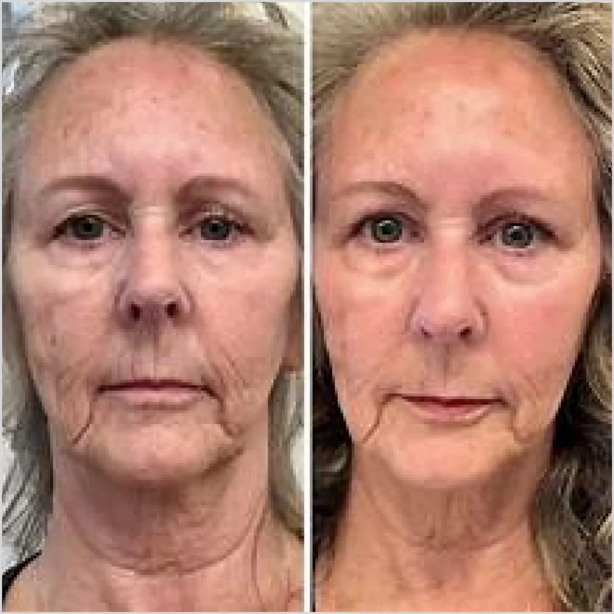 BIOSKIN - BSK36 COLLAGEN-HA PRO - Made in Spain