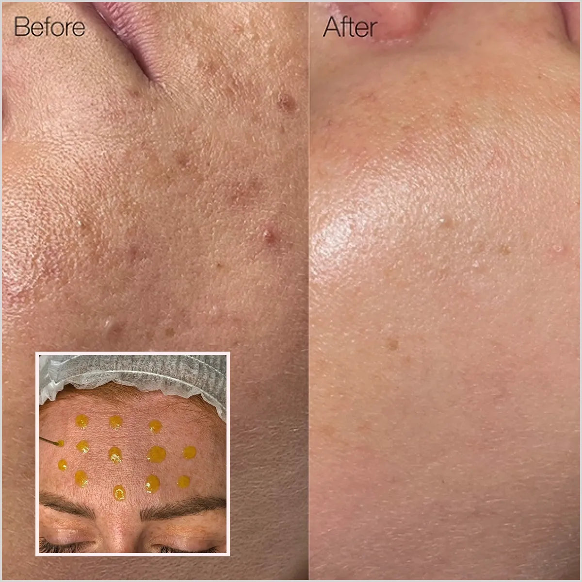 BioRePeel Cl3 - TCA 35% Chemical Peel Price In Pakistan - Made in Italy