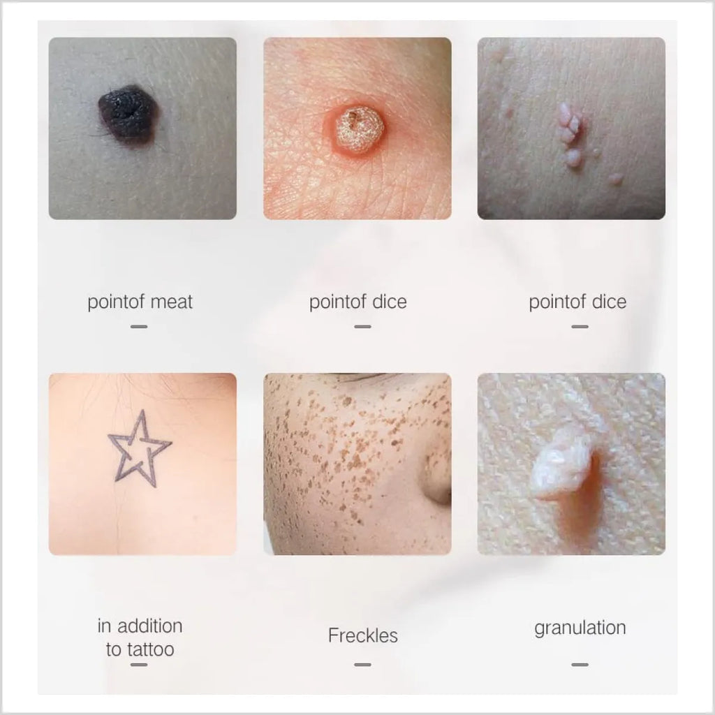 Min Freckle Mole Removal Pen Portable Removal Spot Without Hurting Skin Laser Plasma Pen Mole Tattoo Beauty Tools