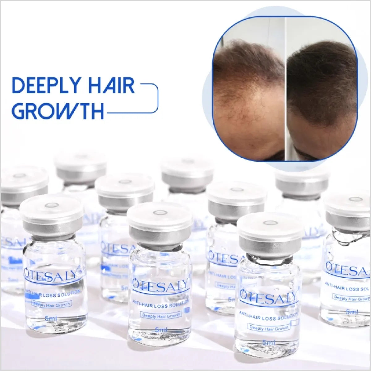 OTESALY Anti-hair Loss Solution - Mesotherapy for Hair Regrowth in Pakistan