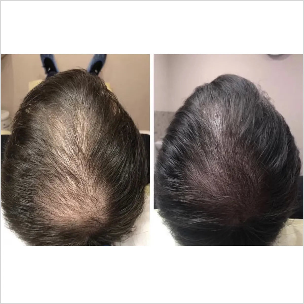 OTESALY H PDRN - Advanced Hair Regrowth Serum Mesotherapy for Hair