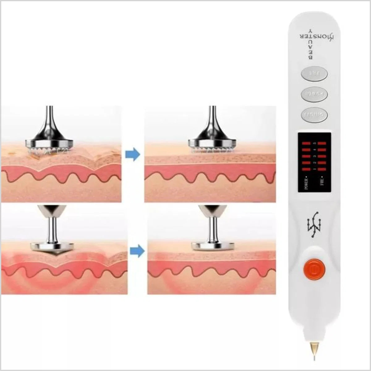 Advanced Beauty Monster Plasma Pen For Stretch Marks
