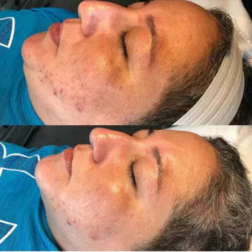 Dr. Pen Ultima A6 Microneedling Pen with 12 Pin Needles