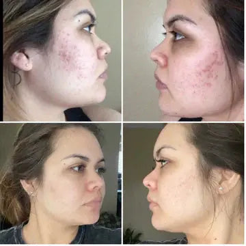 Dr. Pen Ultima A6 Microneedling Pen with 12 Pin Needles