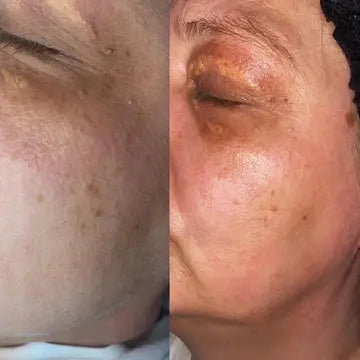 Dr. Pen Ultima A6 Microneedling Pen with 12 Pin Needles
